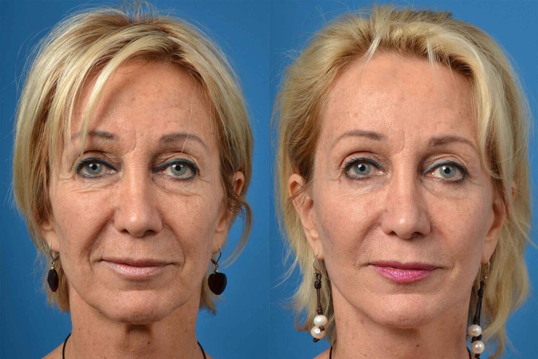 Tupu na mgbe laser resurfacing akpụkpọ