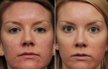 Laser rejuvenation nke ihu n'ihu na mgbe ọ gachara