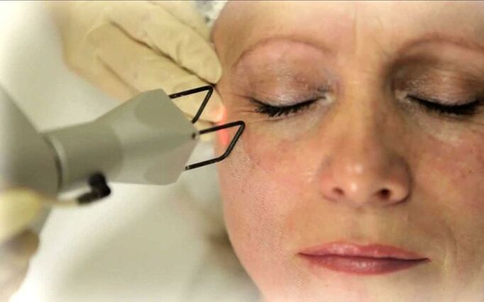laser mwepụ nke wrinkles gburugburu anya
